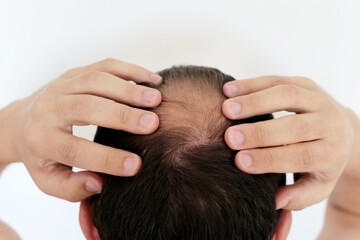 Beginning to go bald man concerned about hair loss. Male head with a bald on white background