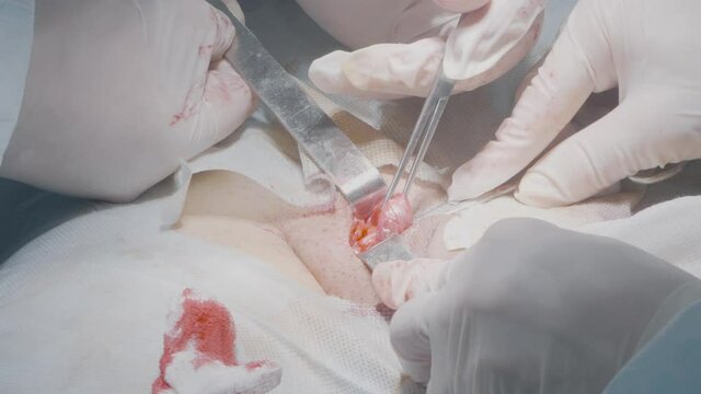 Surgeons remove organ from body. Action. Surgeons open incision to get to organ. Internal organ surgery or appendicitis removal