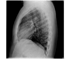 x ray image of a chest