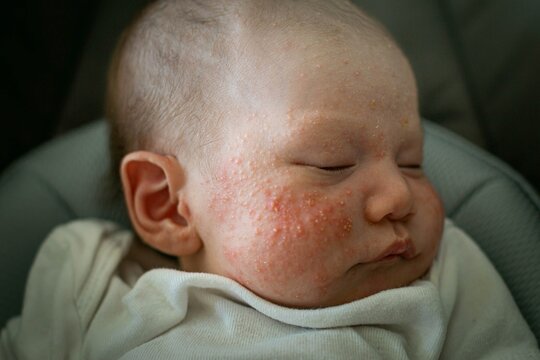 A newborn baby suffering from baby acne, cradle cap, and eczema on the face and cheeks.