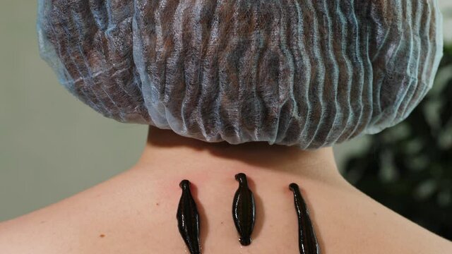 Three leeches on patient's neck, close-up. Hirudotheraphy concept. High quality 4k footage