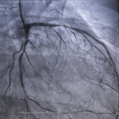 Coronary angiogram (CAG) was performed left anterior descending artery (LAD) stenosis.