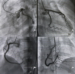 Coronary angiogram (CAG) was performed left and right coronary artery stenosis in multiple views.