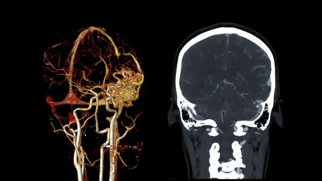 Compare of CTA Brain or computed tomography angiography of the brain 3D and Coronal MIP image showing Brain AVM or arteriovenous malformation turn around on the screen.
