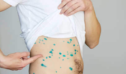 Body of adult  man have spotted, red pimple and bubble rash from chickenpox or varicella zoster...