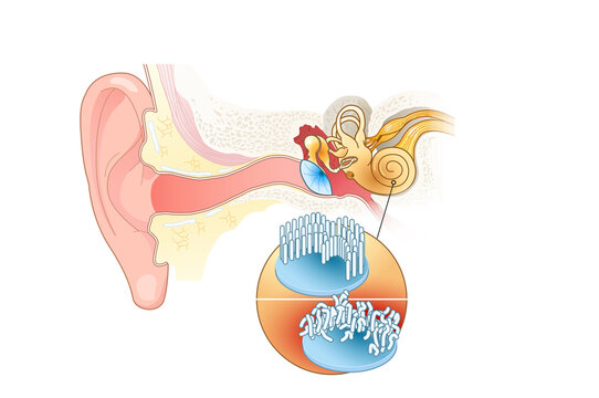 Tinnitus, Healthy And Damaged Hair Cells