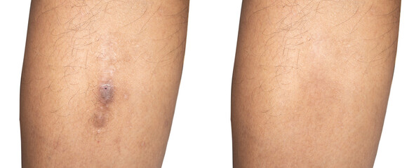 Before and after the scar after the treatment Rehabilitation of wounds from accidents, burns, dermatitis.
