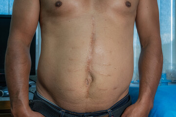 Fototapeta premium Male patient with abdominal surgical scar. Medical themes