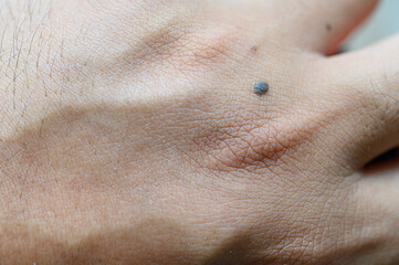 Hand back skin with deep groove texture and mole