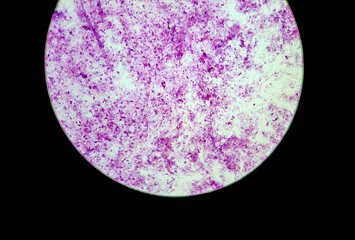 Microscopic section of urothelial high grade bladder cancer. Medical themes