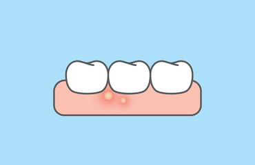 The gumboil and white teeth. illustration vector design on blue background. Dental care concept.