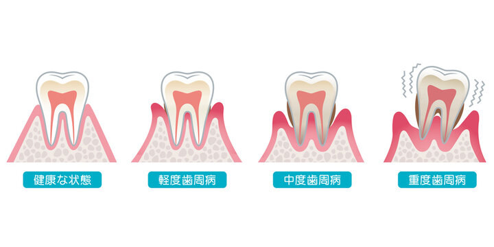 歯周病の進行　医療