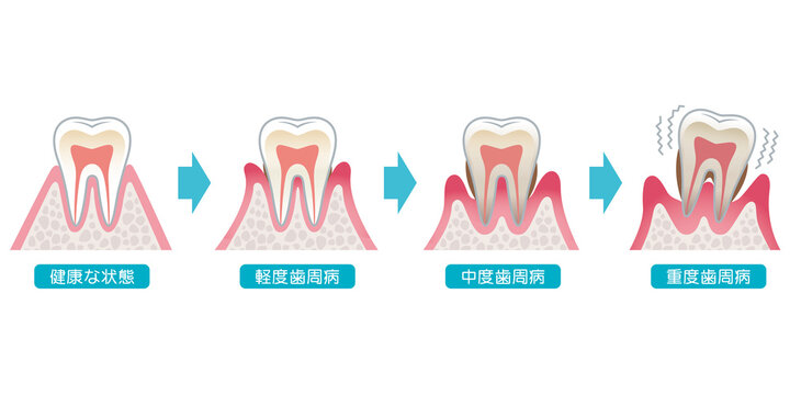 歯周病の進行　医療