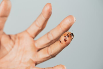 Close up of man hand with sutured wound on finger. Injured, Helth and medical Concept.