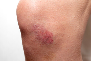 Big red bruise on the knee. Injured knee joint. Hematoma.