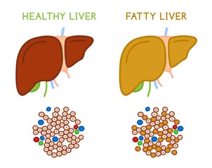 Healthy and fatty liver. Medical vector infographic.