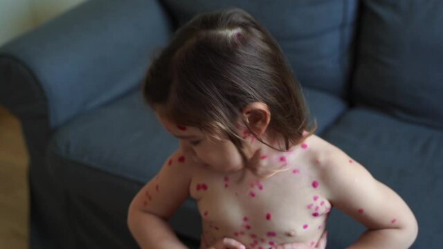Toddler girl with chickenpox measles on the body. Varicella virus childhood contagious disease. Itchy red blisters, fever, pain symptoms. 