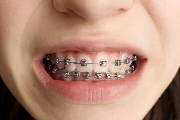 Orthodontic treatment. Dental care concept. Smiling teenage girl with braces. Metal braces close-up...