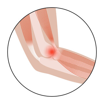 Lateral epicondylitis tennis elbow