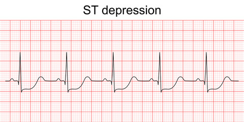 Electrocardiogram show ST segment depression pattern. Heart attack. Ischemic. Coronary artery disease. Angina pectoris. Chest pain. ECG. EKG. Medical health care.
