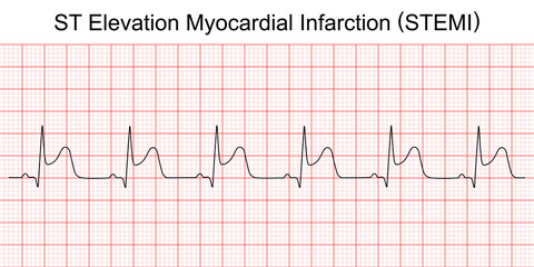 Electrocardiogram show ST elevation myocardial infarction (STEMI) pattern. Heart attack. Ischemic. Coronary artery disease. Angina pectoris. Chest pain. ECG. EKG. Medical health care. - obrazy, fototapety, plakaty