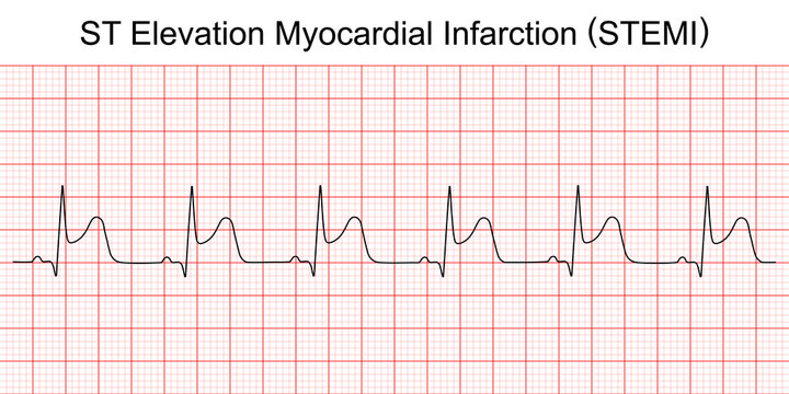 Electrocardiogram show ST elevation myocardial infarction (STEMI) pattern. Heart attack. Ischemic. Coronary artery disease. Angina pectoris. Chest pain. ECG. EKG. Medical health care.