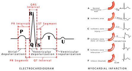 The heart cycle. Normal ECG. Myocardial infarction - ECG. Wave changes during evolution of myocardial damage. Myocardial infarction in the posterior wall and an occlusion of the circumflex artery.