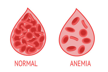 Anemia. Comparison of a drop of blood with normal and anemic blood cells. Isolated vector image on white background. Anemia concept.