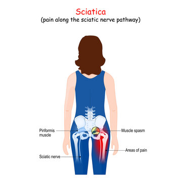 Sciatica.  Body of a patient (woman) with areas of pain from the back. Piriformis