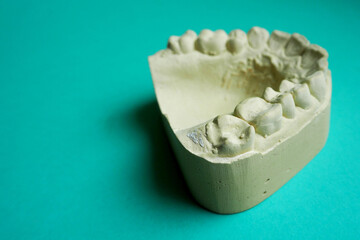 the plaster upper jaw lies on a turquoise background, side view. children's dentistry. dental treatment © NataSel