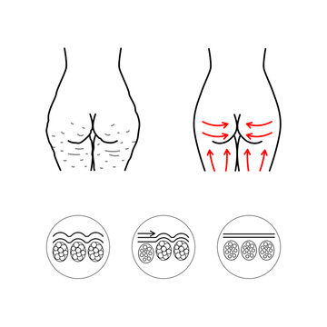 Anti-cellulite icons set editable stroke