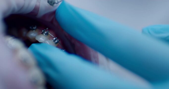 Close-up teeth with a bracket system and medical hand is taking out a stainless steel archwire broad form detail with metal details from the lower jaw by using a dental probe.
