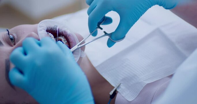 Close-up a female patient face with an optragate on her mouth and laying in the dental chair while a medical hand is inserting a multiloop edgewise archwire on an upper jaw by using dental scissors.