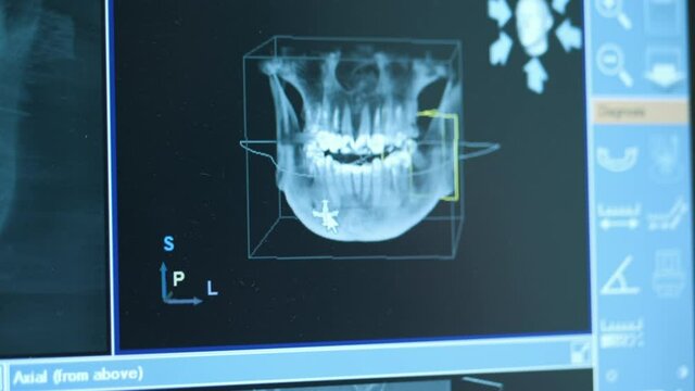 Close-up of doctor dentist looks at looks 3d model of x-rays of the patient's jaw and teeth on the monitor, modern dentistry
