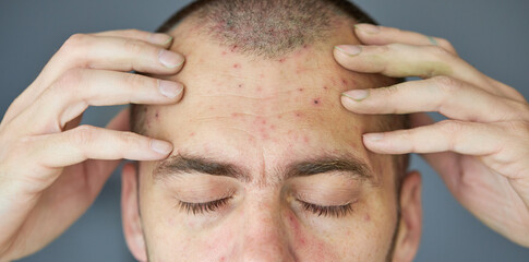 Body of adult  man have spotted, red pimple and bubble rash from chickenpox or varicella zoster...