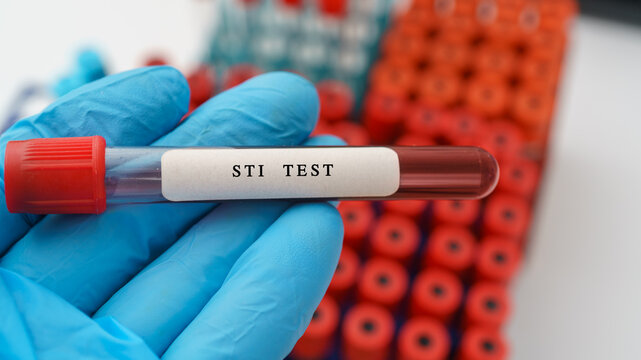  STI (sexually transmitted infection) test result with blood sample in test tube on doctor hand in medical lab.