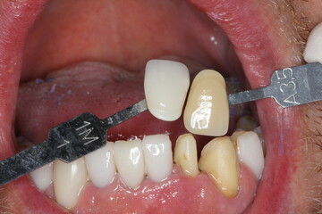new teeth for the patient. new smile. match the color with the teeth. 