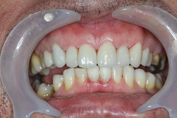 Obraz premium new teeth for the patient. new smile. match the color with the teeth. 