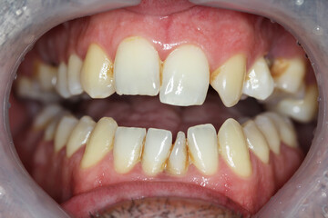 Fototapeta premium new teeth for the patient. new smile. match the color with the teeth. 