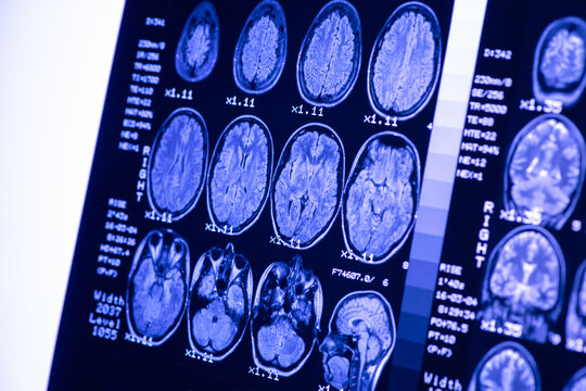 MRI of  brain of a healthy person with blue illumination. Magnetic resonance scan. Medical healthcare concept