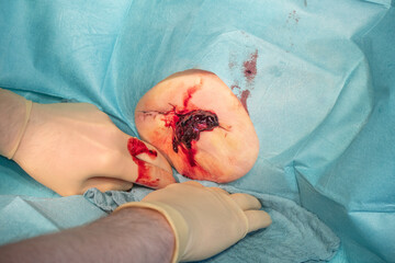 in the operating room a hematoma of a patient is operated by a doctor