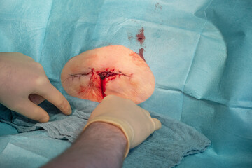 in the operating room a hematoma of a patient is operated by a doctor