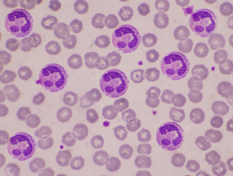 Neutrophil with vacular on red blood cell.