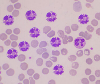 Neutrophil with vacular on red blood cell.