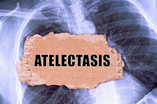 On the X-ray there is a piece of cardboard with the inscription - Atelectasis