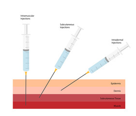 Differents Syringe Angles injections. Intramuscular, subcutaneous and Intradermal injections