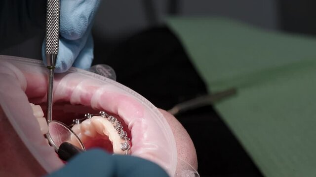 Cleaning of teeth braces in dental clinic. Modern Orthodontics. Patient in medical chair. Close up
