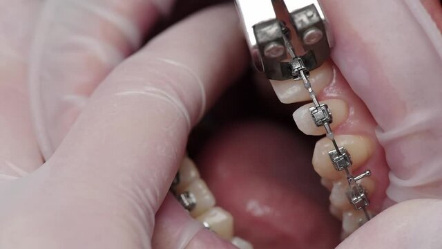 Removal of braces in dentist office. Modern Orthodontics. Patient in medical chair.