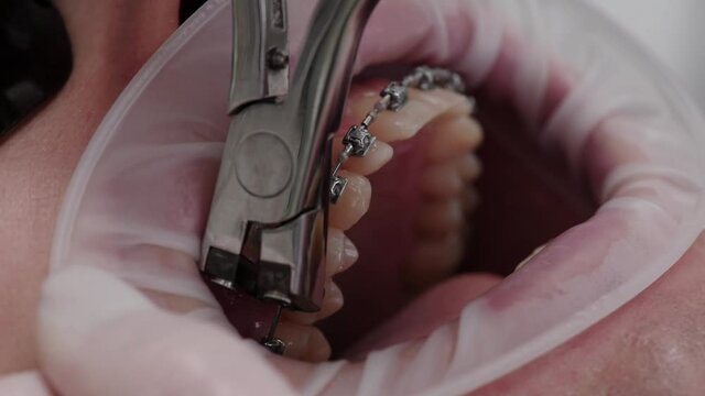 Removal of braces in dentist office. Modern Orthodontics. Patient in medical chair.