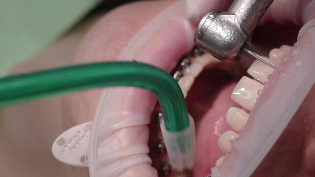 Process of removing braces. Teeth polishing. Patient in the dental chair. Modern orthodontics. Smooth beautiful teeth. Close up